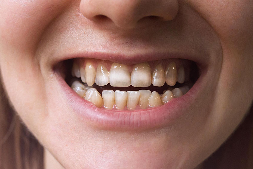 Everything About High Intense Tooth Diseases Elegantdentcare Blog