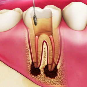 root canal in elegant dental care