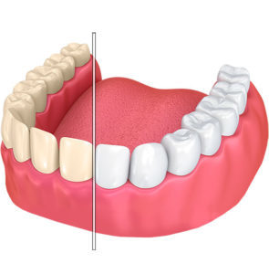 teeth whitening in elegant dental care