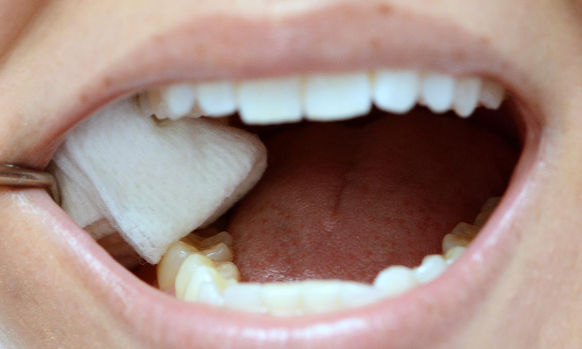 How Long To Keep Gauze In After Wisdom Tooth Extraction