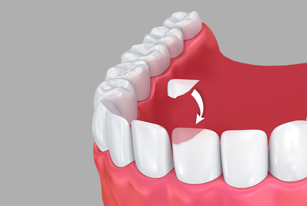 What Causes Craze Lines on Front Teeth? Elegantdentcare Blog