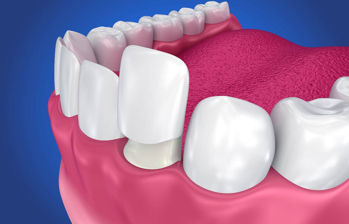 What Causes Craze Lines on Front Teeth?