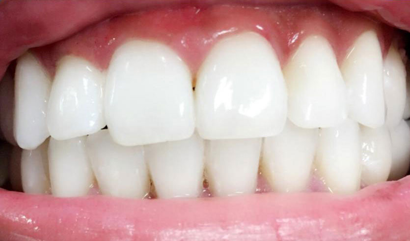 Tooth-Whitening-After