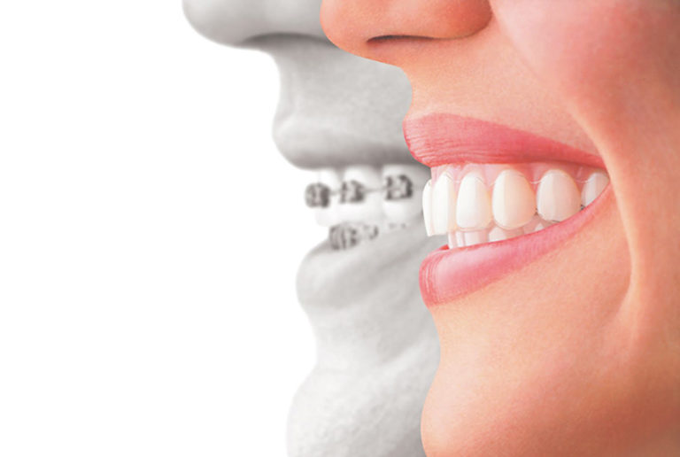 Invisalign Cost What You Need to Know (Updated 2019) Elegantdenta