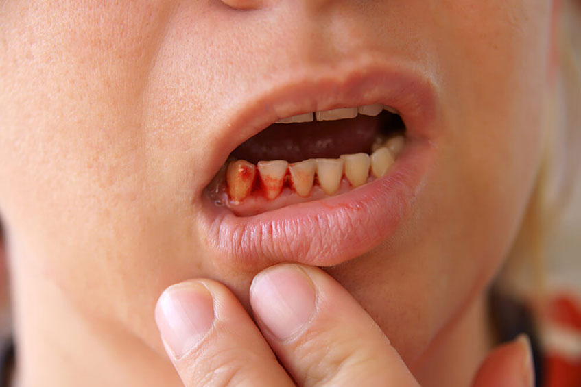 Bleeding tooth diseases