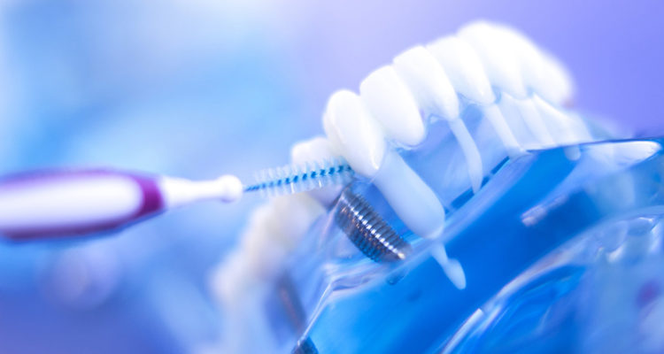Dental implant cleaning and aftercare