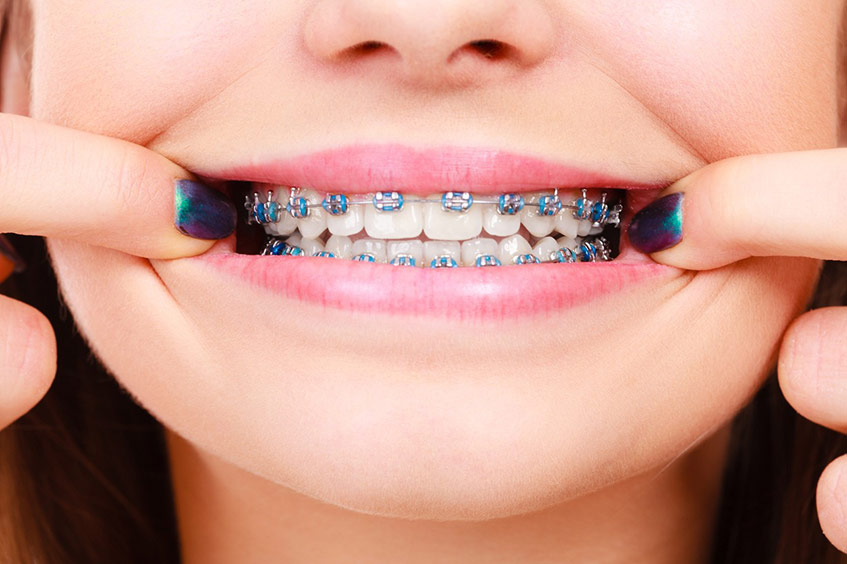 Metal braces