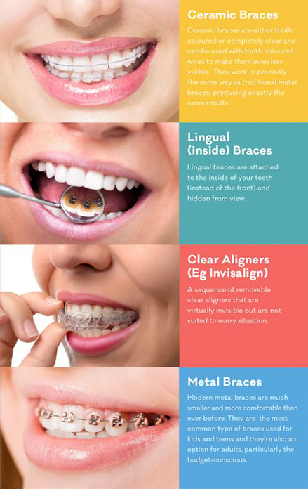 Different types of dental braces