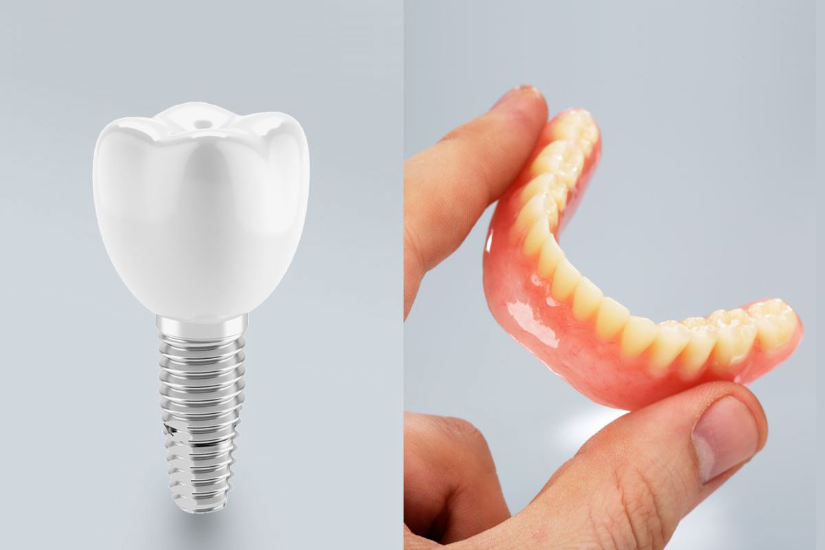 Dental Implants vs Dentures (Pros & Cons of Each) Elegant Dental Care
