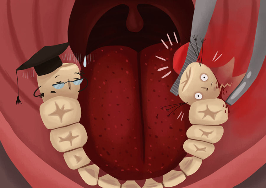 Wisdom Tooth Removal